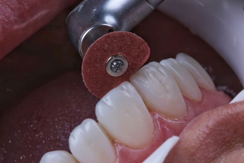 Estratificação em Resina Composta com Empress Direct - Ivoclar