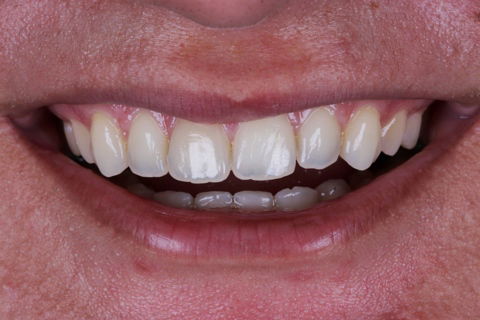 Estratificação em Resina Composta com Empress Direct - Ivoclar