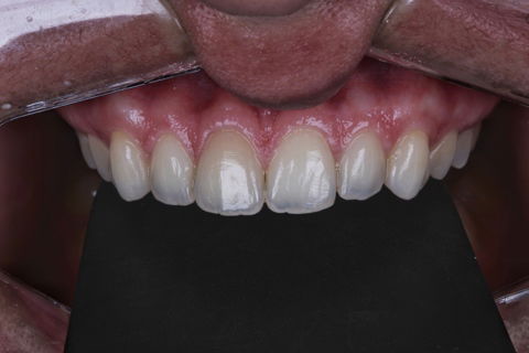 Estratificação em Resina Composta com Empress Direct - Ivoclar