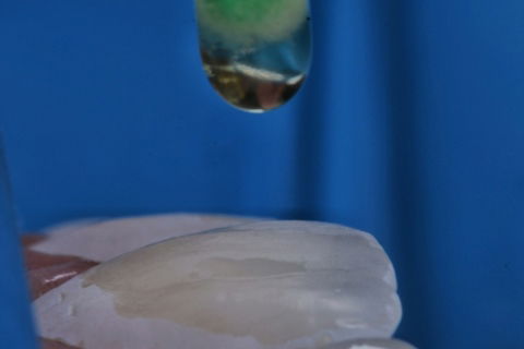 Estratificação em Resina Composta com Empress Direct - Ivoclar