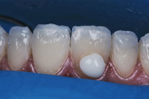 Estratificação em Resina Composta com Empress Direct - Ivoclar