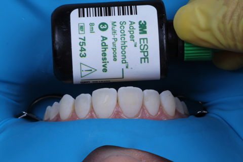 Estratificação em Resina Composta com Empress Direct - Ivoclar