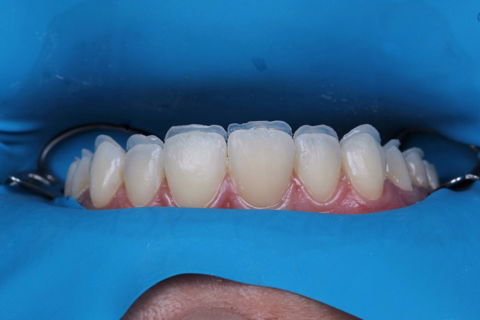 Estratificação em Resina Composta com Empress Direct - Ivoclar