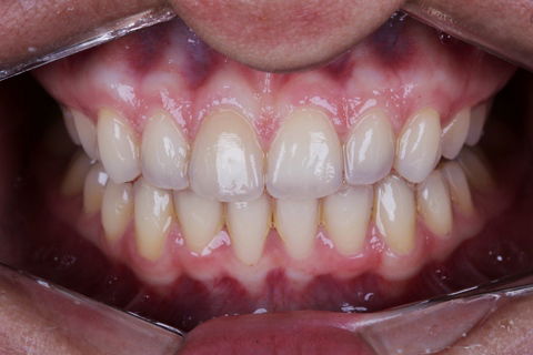 Estratificação em Resina Composta com Empress Direct - Ivoclar