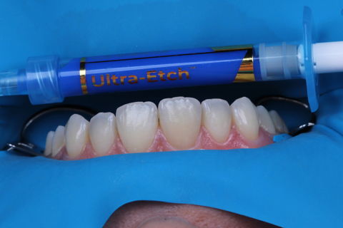 Estratificação em Resina Composta com Empress Direct - Ivoclar