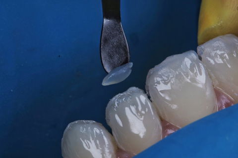 Estratificação em Resina Composta com Empress Direct - Ivoclar