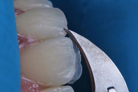 Estratificação em Resina Composta com Empress Direct - Ivoclar