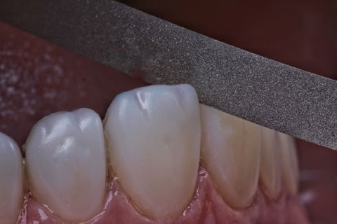 Estratificação em Resina Composta com Empress Direct - Ivoclar