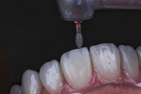 Estratificação em Resina Composta com Empress Direct - Ivoclar