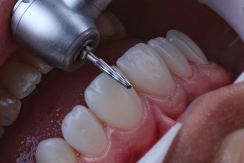 Estratificação em Resina Composta com Empress Direct - Ivoclar