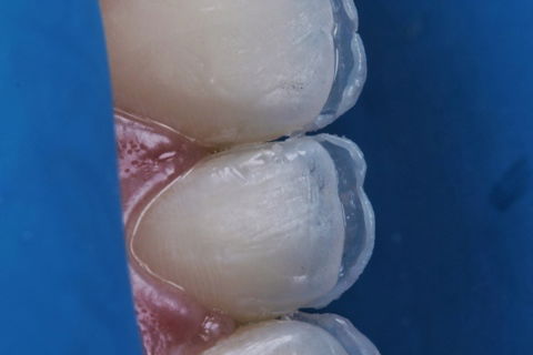 Estratificação em Resina Composta com Empress Direct - Ivoclar