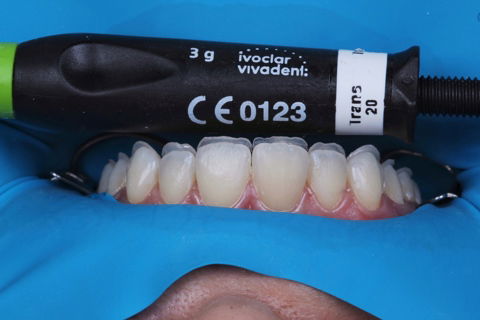 Estratificação em Resina Composta com Empress Direct - Ivoclar