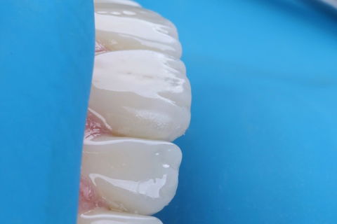 Estratificação em Resina Composta com Empress Direct - Ivoclar