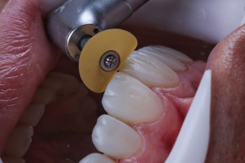 Estratificação em Resina Composta com Empress Direct - Ivoclar