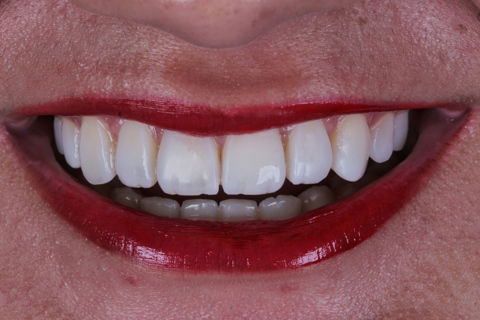 Estratificação em Resina Composta com Empress Direct - Ivoclar