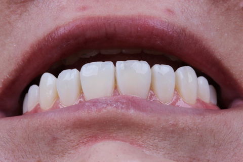 Estratificação em Resina Composta com Empress Direct - Ivoclar