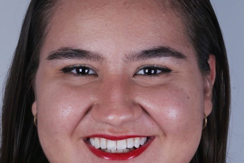 Estratificação em Resina Composta com Empress Direct - Ivoclar