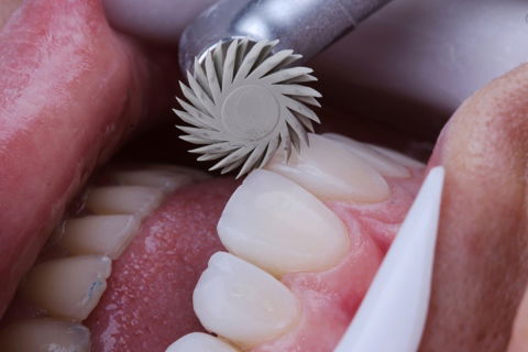 Estratificação em Resina Composta com Empress Direct - Ivoclar