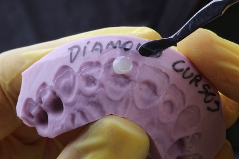 Estratificação em Resina Composta com Empress Direct - Ivoclar