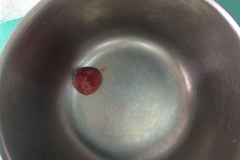 Remoção de Cisto Periapical