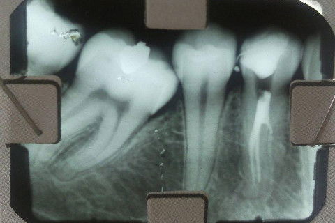 Pré-Molar Inferior com 2 Canais
