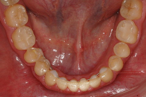 MORFOLOGIA DO ARCO SUPERIOR APÓS A MECÂNICA (CARRIERE) E PROTOCOLO DE FIOS D' FRANCO, CONTENÇÃO INFERIOR.