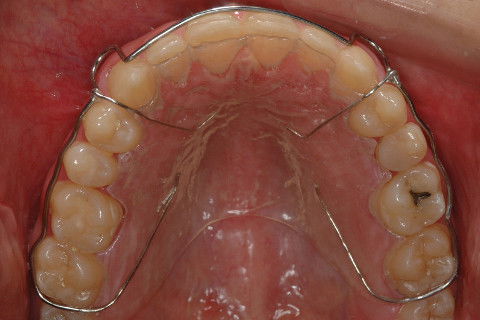 CONTENÇÃO SUPERIOR, PLACA DE HAWLEY.