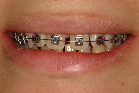 AUTOLIGADO CARRIERE, FIO 016