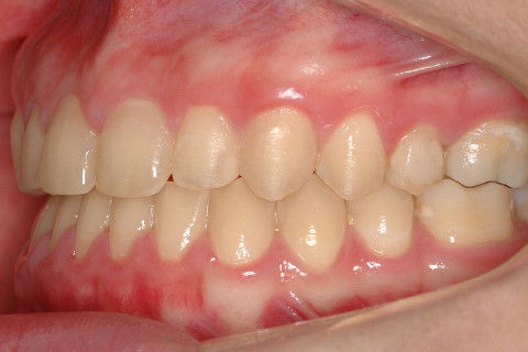 INTERCUSPIDAÇÃO FINAL DO LADO ESQUERDO