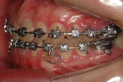 ALINHAMENTO E NIVELAMENTO, PROTOCOLO D' FRANCO.