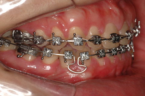 FECHAMENTO DOS ESPAÇOS NO ARCO INFERIOR. ALÇA COGUMELO.