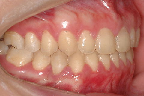 INTERCUSPIDAÇÃO FINAL DO LADO DIREITO