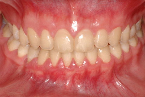 FRONTAL INTRABUCAL, FINAL. VEJA QUE O APARELHO AUTOLIGADO APRESENTA EXCELENTE POTENCIAL DE CORREÇÃO TRANSVERSAL NO ARCO SUPERIOR