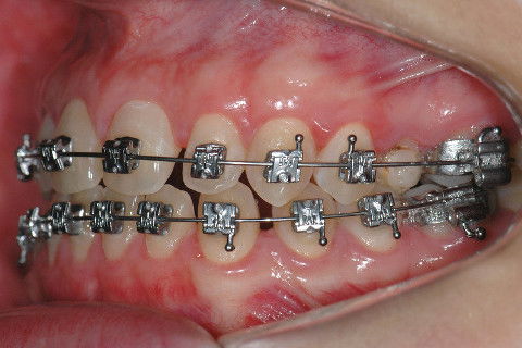ALINHAMENTO E NIVELAMENTO, PROTOCOLO D' FRANCO.