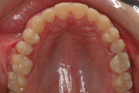 MORFOLOGIA DO ARCO SUPERIOR APÓS A MECÂNICA (CARRIERE) E PROTOCOLO DE FIOS D' FRANCO.