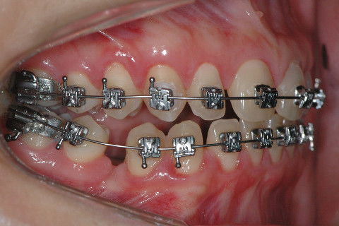 ALINHAMENTO E NIVELAMENTO, PROTOCOLO D' FRANCO.