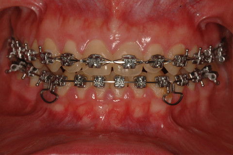 FECHAMENTO DOS ESPAÇOS NO ARCO INFERIOR. ALÇA COGUMELO.