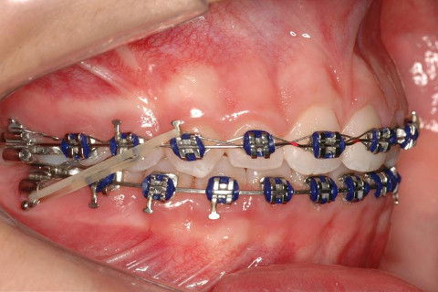 FINALIZAÇÃO; ELÁSTICO DE CLASSE II SIMPLES.