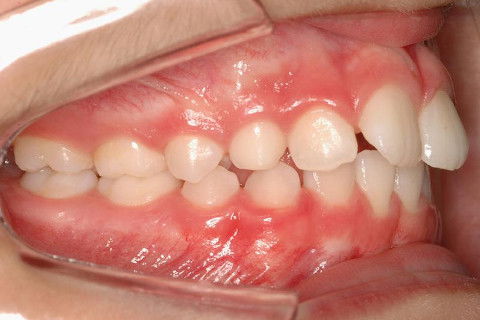 LATERAL DIR. INICIAL