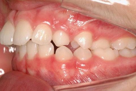 LATERAL ESQ. INICIAL