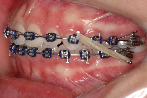 FINALIZAÇÃO; ELÁSTICO DE CLASSE II DUPLO.