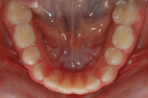 OCLUSAL INF. INICIAL.