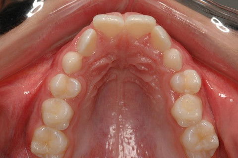 OCLUSAL SUP. INICIAL