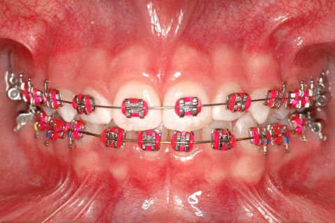 INSTALAÇÃO APARELHO FIXO SUPERIOR E INFERIRO (ROTH)