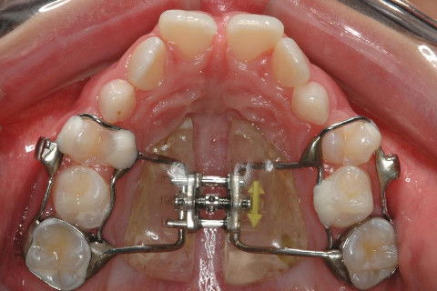HAAS MULTIFUNÇÃO ATIVADO.