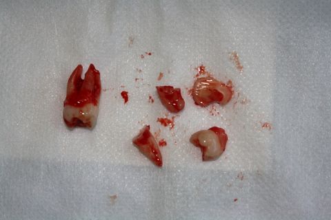 elementos extraídos