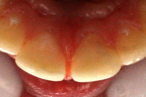 Palatina com polimento final.