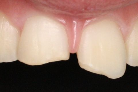 Visualização da borda fraturada.