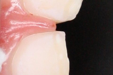 Condicionamento do esmalte.