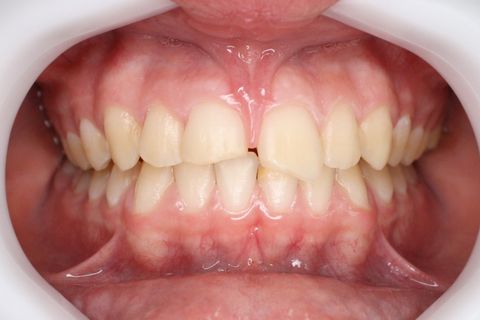 Aspecto clínico inicial ocluindo.